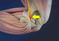 Cubital Tunnel Syndrome