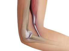 Distal Biceps Rupture