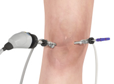 Knee Arthroscopy