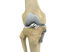 Knee Osteotomy