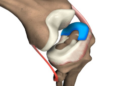 Meniscal Transplant Surgery