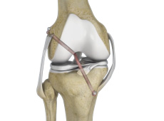 Multiligament Reconstruction