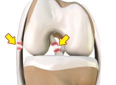 Multiligament Instability