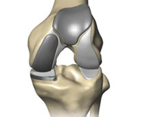 Partial Knee Replacement