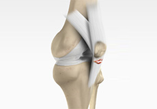 Patella Tendon Rupture