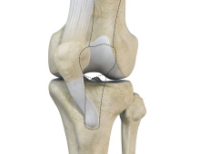 Patellar Instability