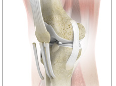 ACL Reconstruction Patellar Tendon