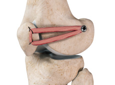 Patellofemoral Knee Replacement