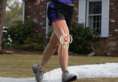 Patellofemoral Pain Syndrome