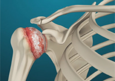 Shoulder Arthritis