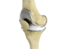 Total Knee Replacement