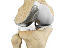 Unicompartmental Knee Replacement